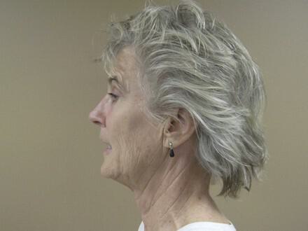 Facelift Before & After Image