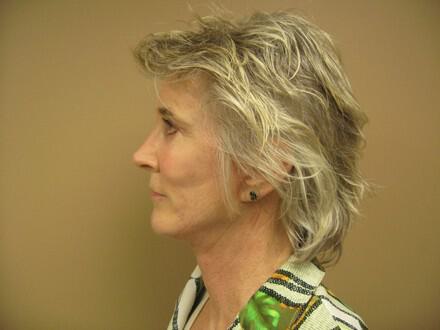 Facelift Before & After Image