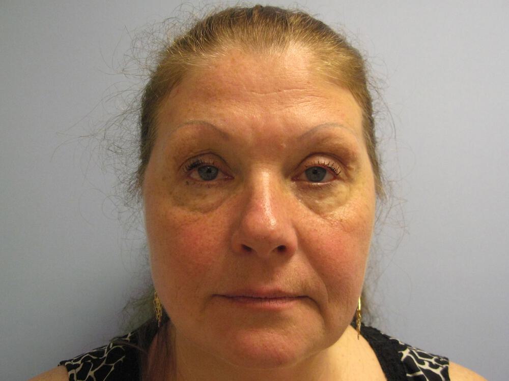 Facelift Before & After Image