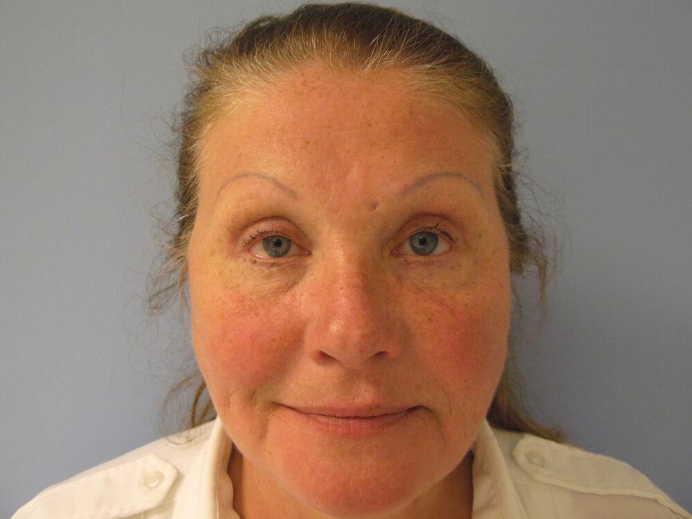 Facelift Before & After Image