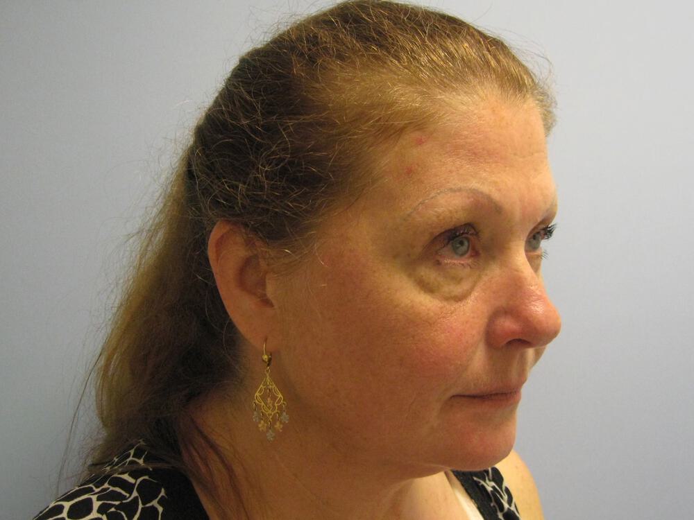 Facelift Before & After Image