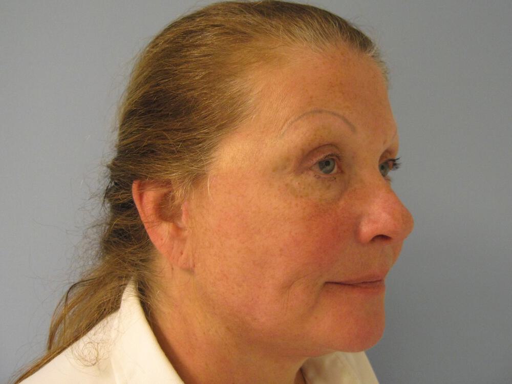 Facelift Before & After Image