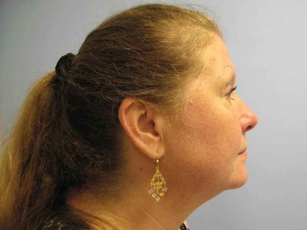 Facelift Before & After Image