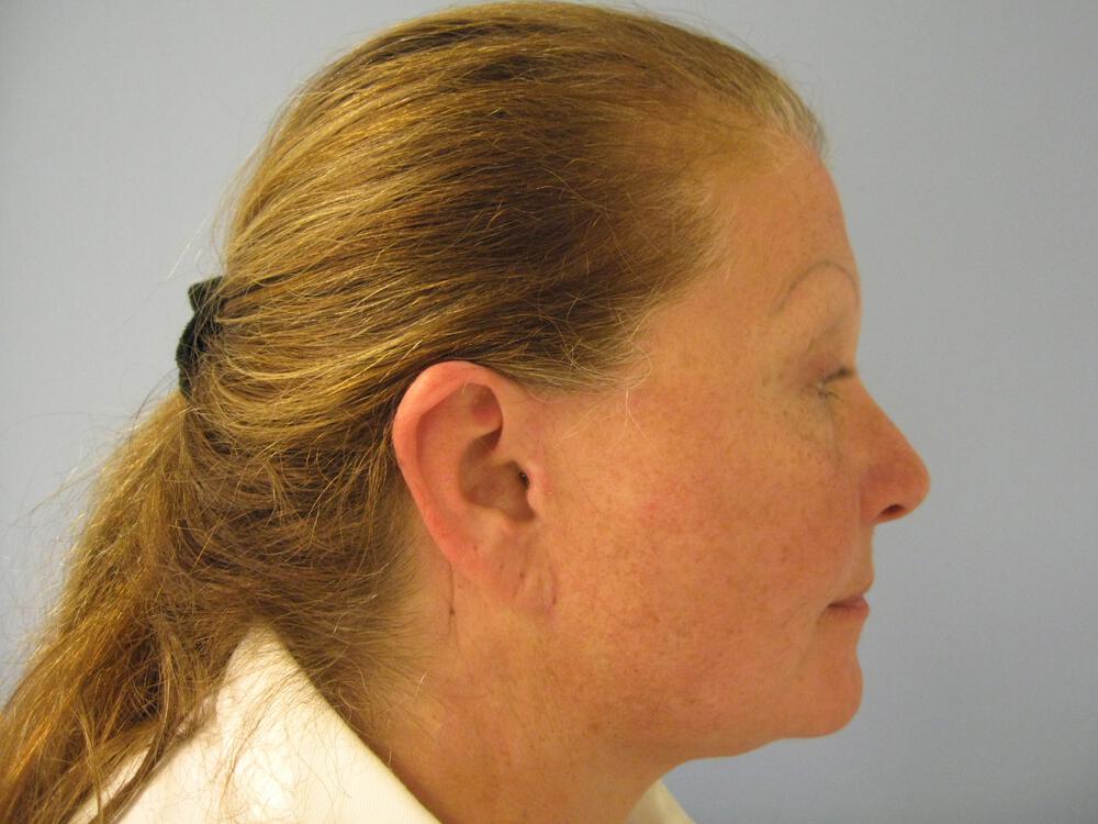Facelift Before & After Image