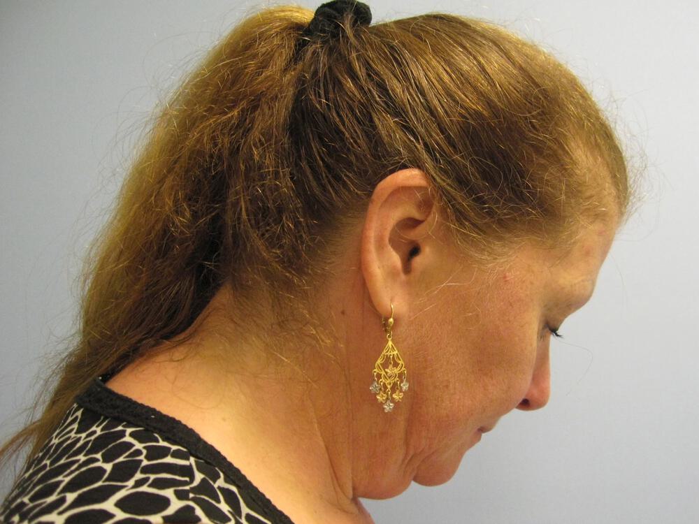 Facelift Before & After Image