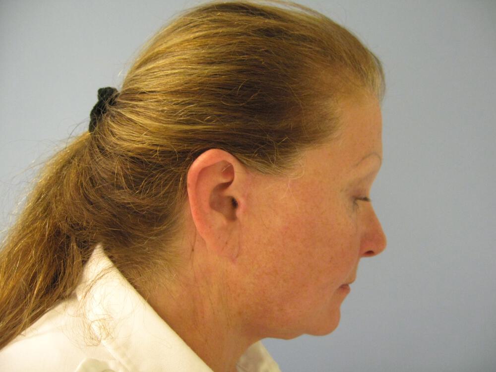 Facelift Before & After Image