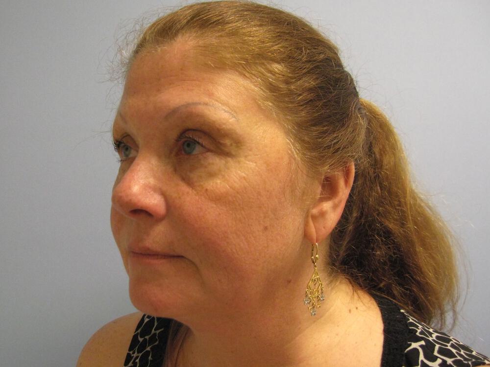 Facelift Before & After Image
