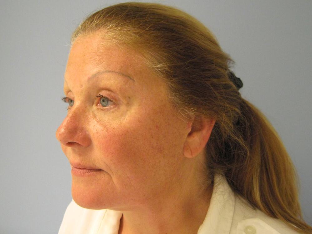 Facelift Before & After Image