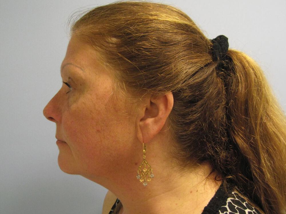 Facelift Before & After Image
