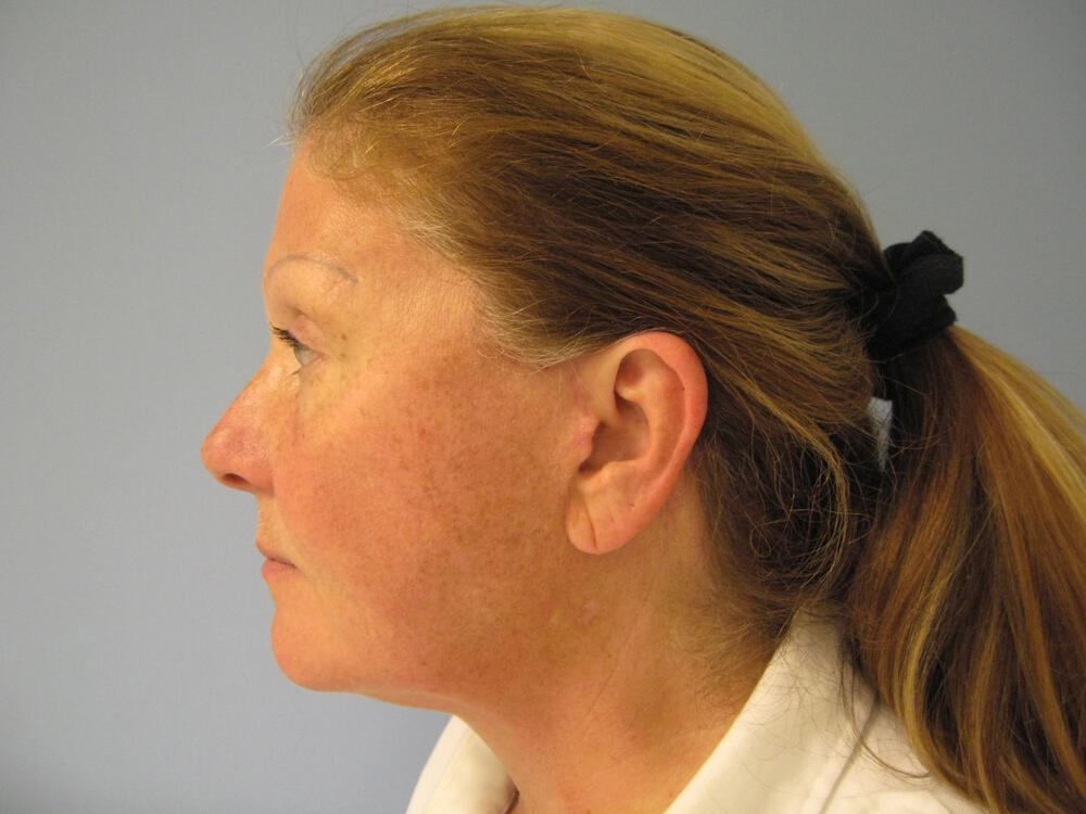 Facelift Before & After Image