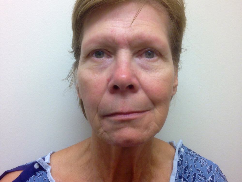 Facelift Before & After Image