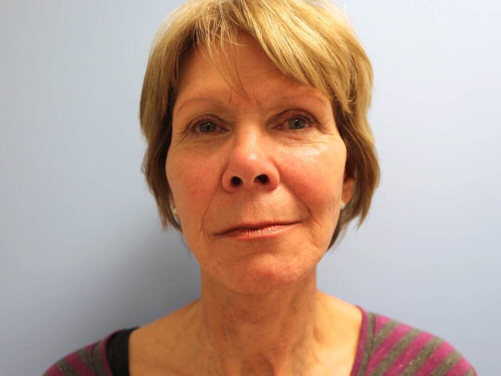 Facelift Before & After Image