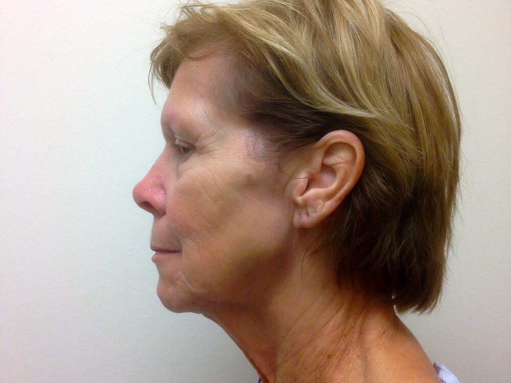 Facelift Before & After Image