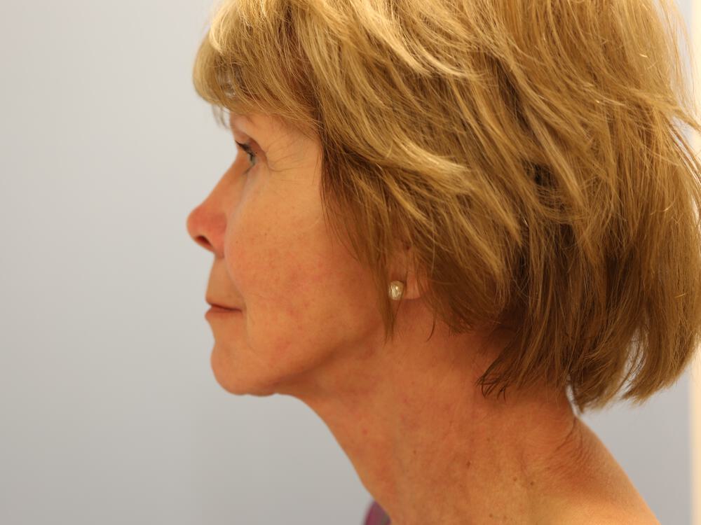 Facelift Before & After Image