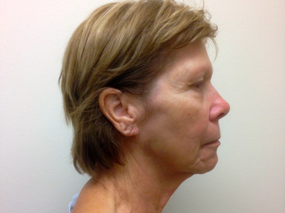 Facelift Before & After Image
