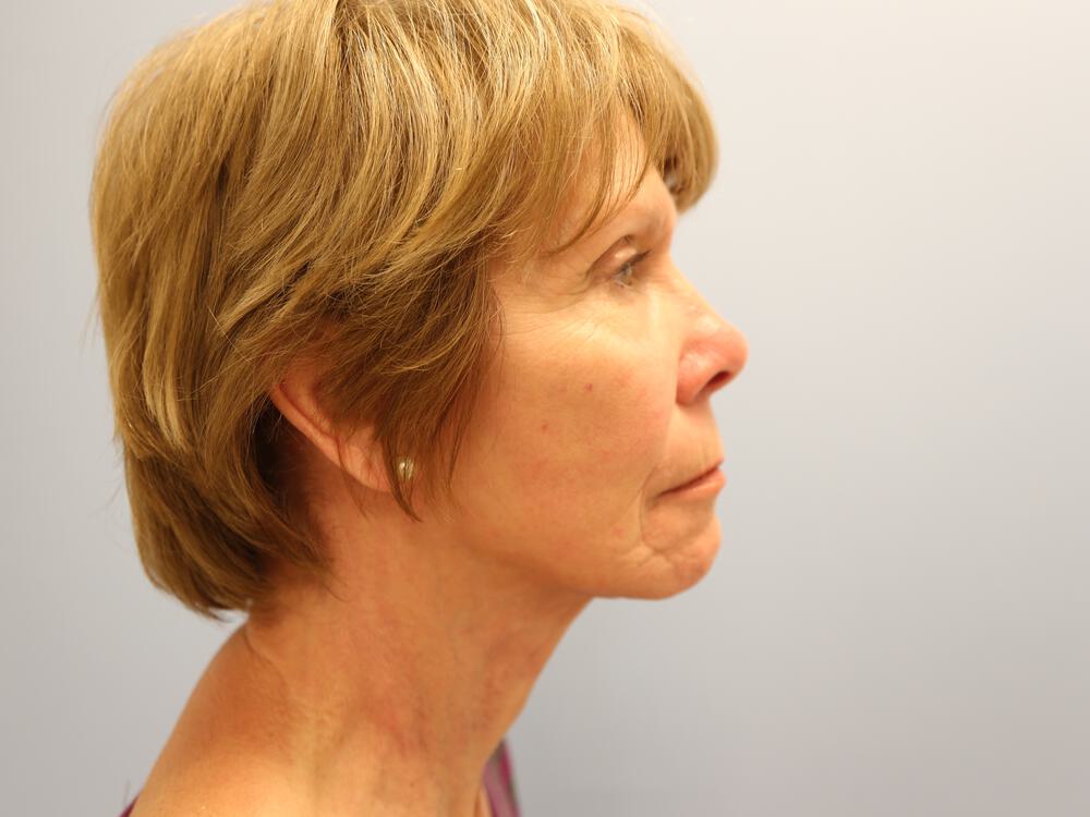 Facelift Before & After Image