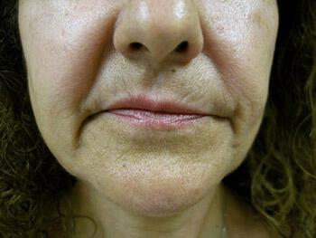 Lip Rejuvenation Before & After Image