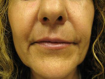 Lip Rejuvenation Before & After Image