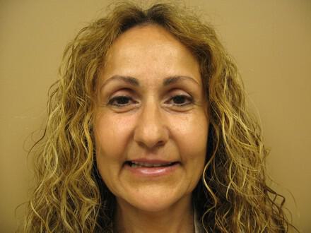 Lip Rejuvenation Before & After Image