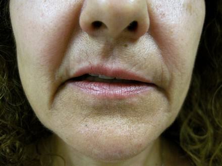 Lip Rejuvenation Before & After Image