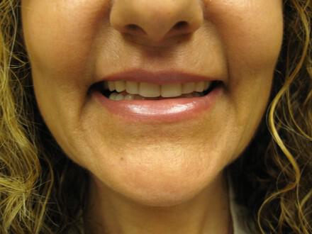 Lip Rejuvenation Before & After Image