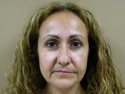 Lip Rejuvenation Before & After Image