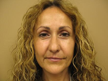 Lip Rejuvenation Before & After Image