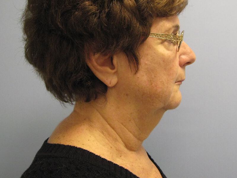 Neck Lift Before & After Image