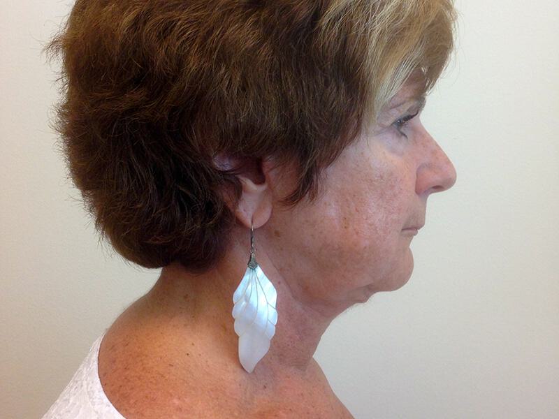 Neck Lift Before & After Image