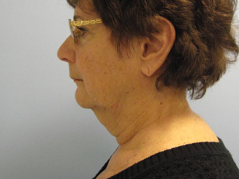 Neck Lift Before & After Image