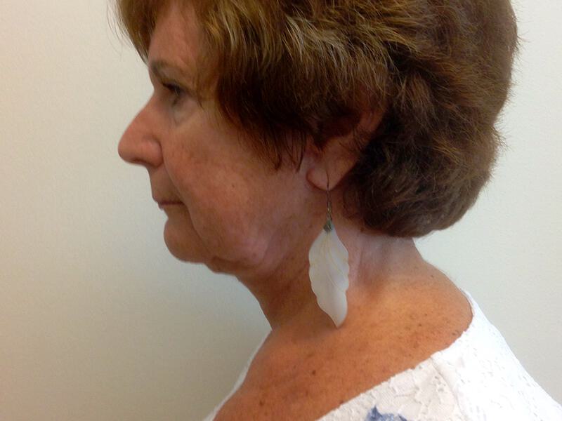 Neck Lift Before & After Image