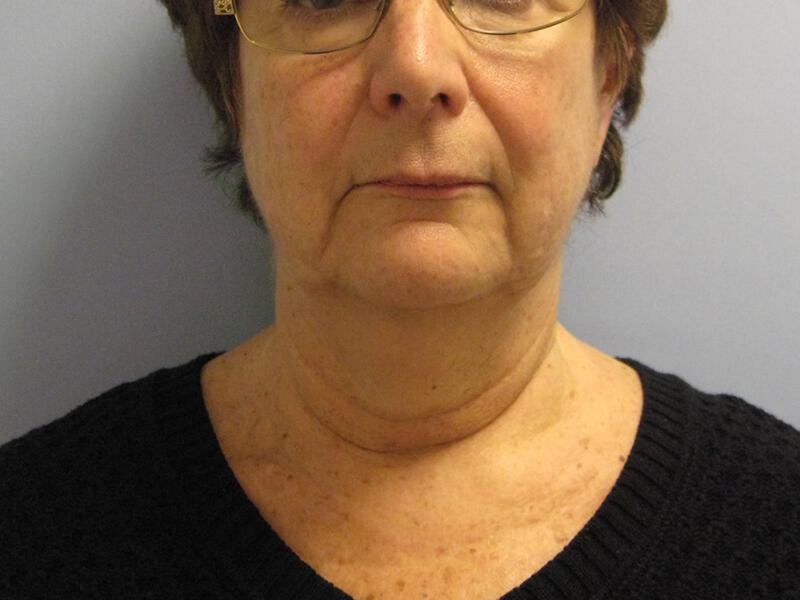 Neck Lift Before & After Image