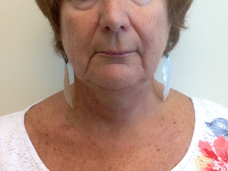 Neck Lift Before & After Image