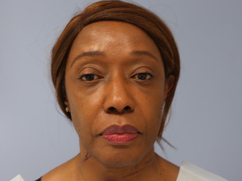Neck Lift Before & After Image