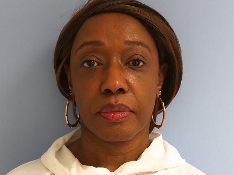 Neck Lift Before & After Image