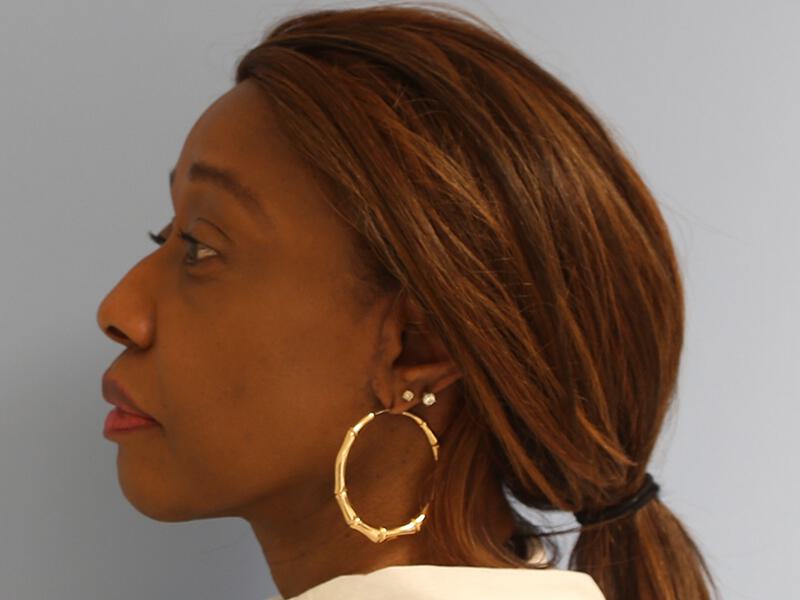 Neck Lift Before & After Image