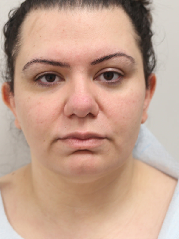 Necklift Before & After Image