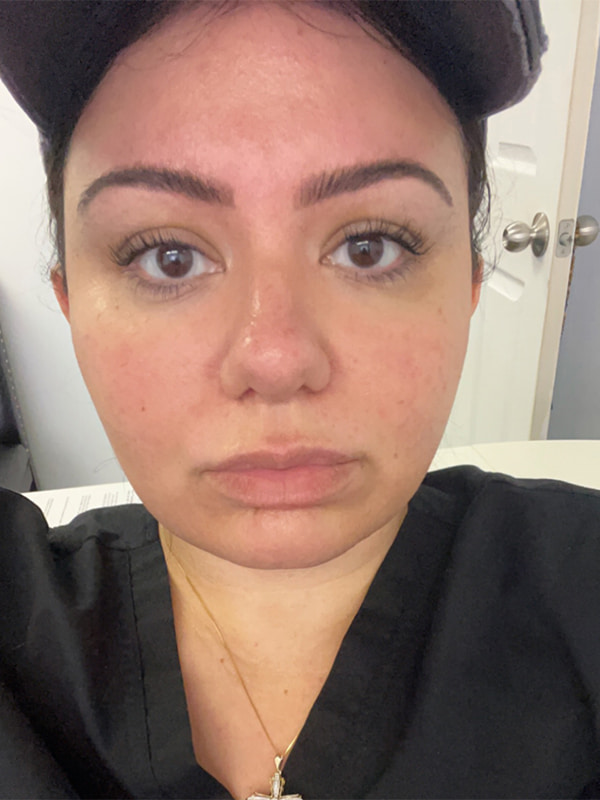 Necklift Before & After Image