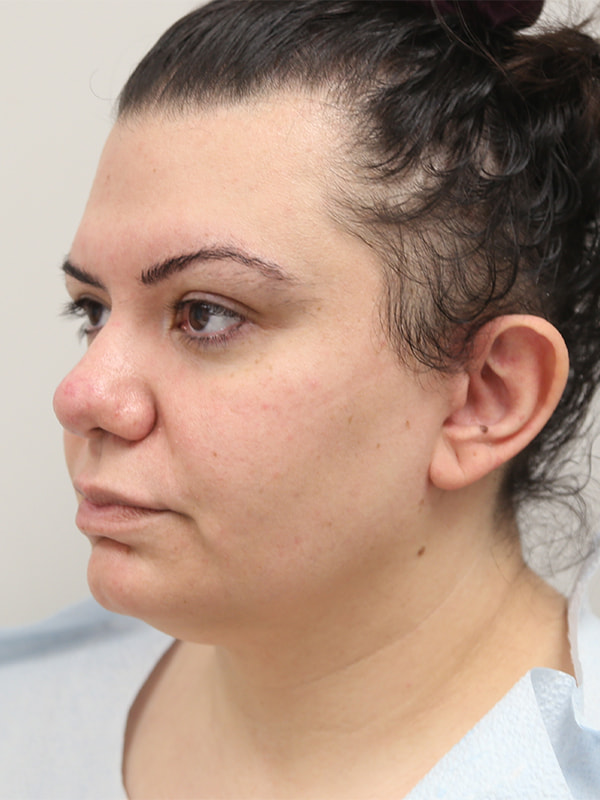 Neck Lift Before & After Image