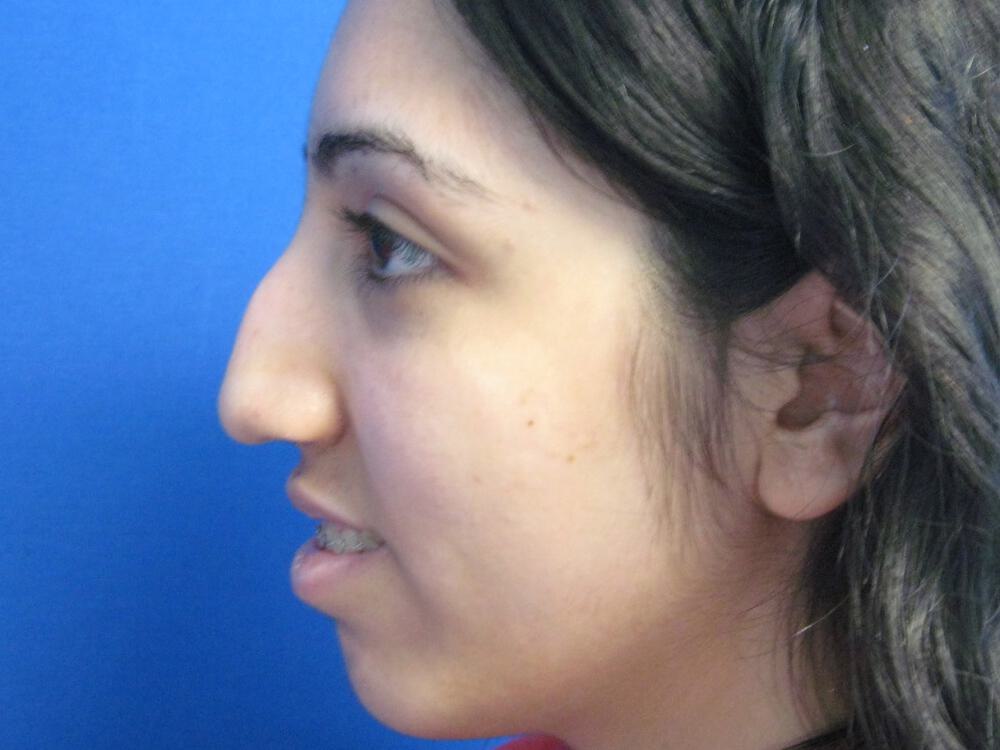 Rhinoplasty Before & After Image