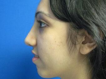 Rhinoplasty Before & After Image