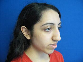 Rhinoplasty Before & After Image