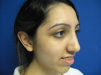 Rhinoplasty Before & After Image