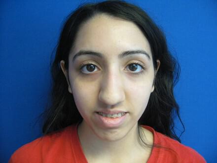 Rhinoplasty Before & After Image