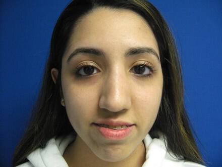 Rhinoplasty Before & After Image