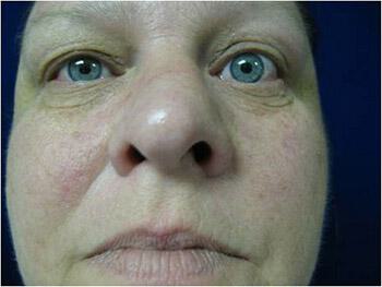 Rhinoplasty Before & After Image