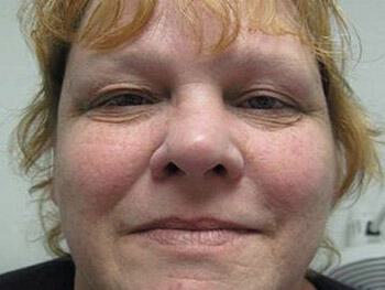 Rhinoplasty Before & After Image