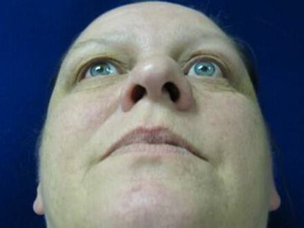 Rhinoplasty Before & After Image