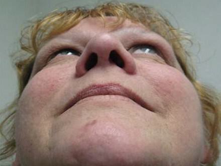 Rhinoplasty Before & After Image