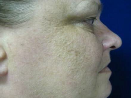 Rhinoplasty Before & After Image